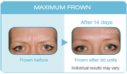 Wrinkle free inejections botox